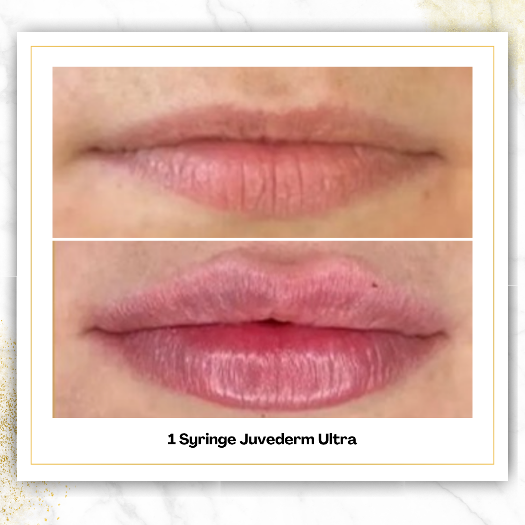 Juvederm Ultra