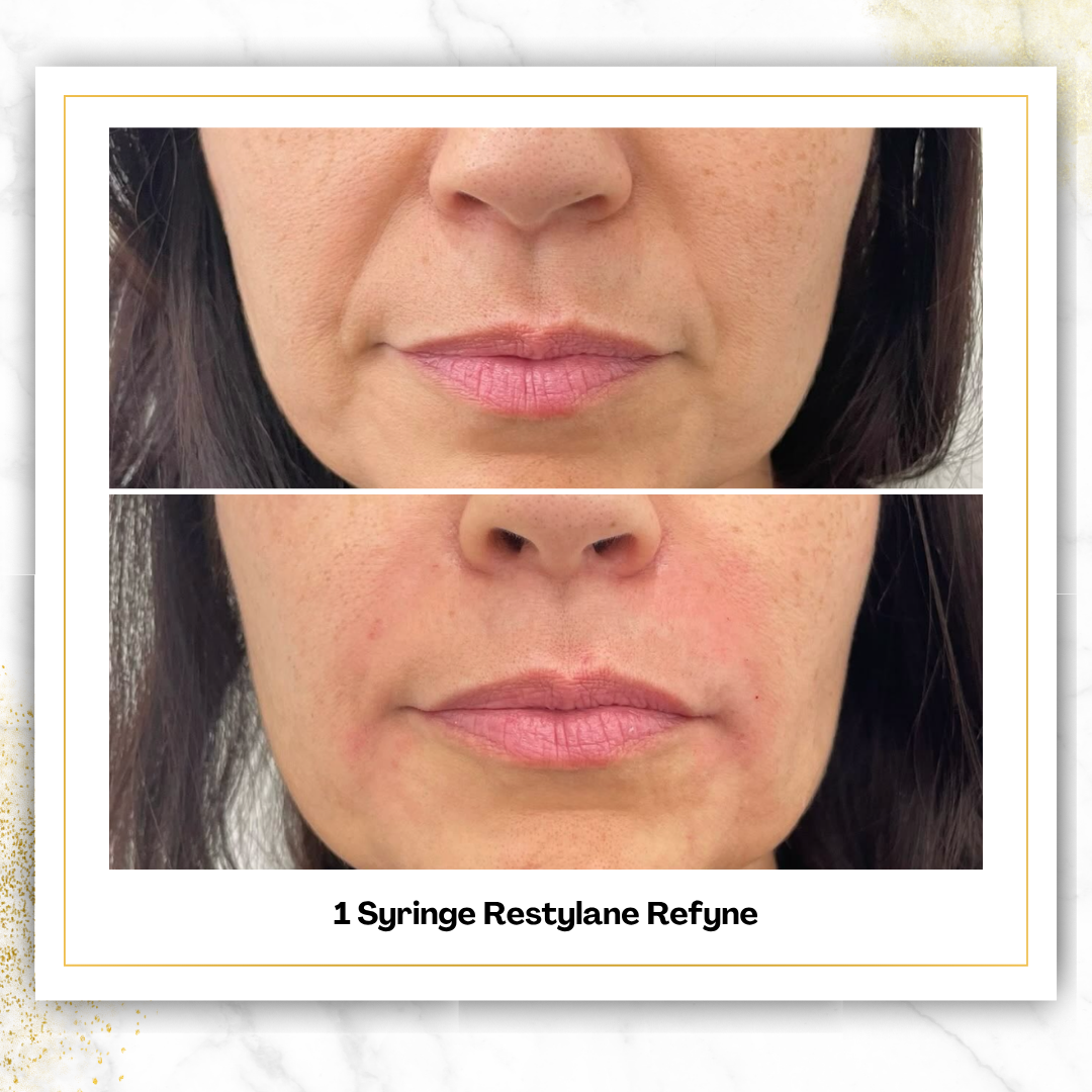 Restylane Refyne