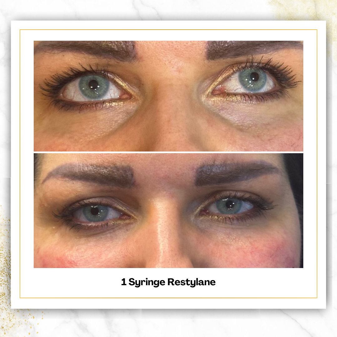 Restylane Under Eye Filler in San Antonio | $850 | DaVida