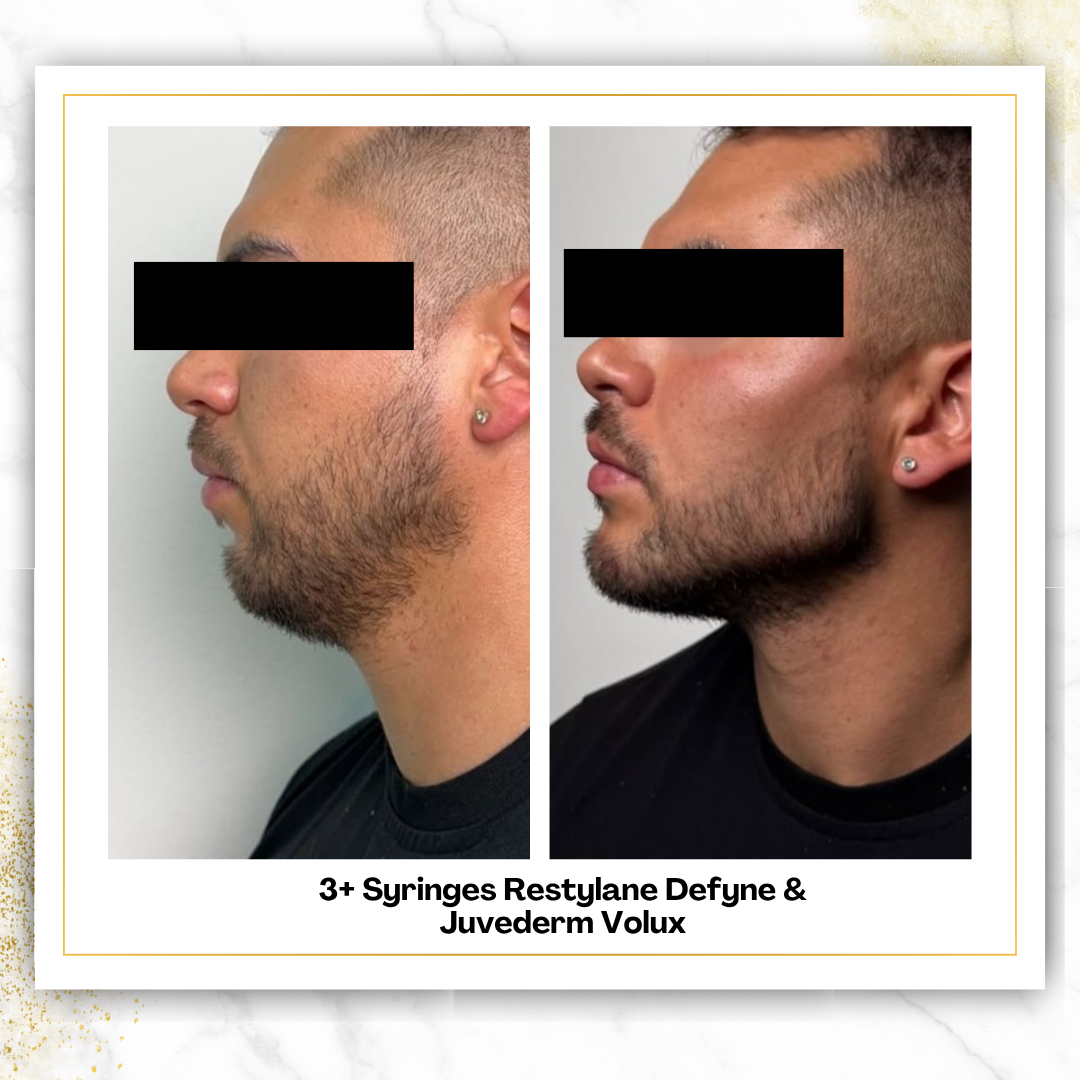 Restylane Contour in San Antonio | Cheek Filler | $750