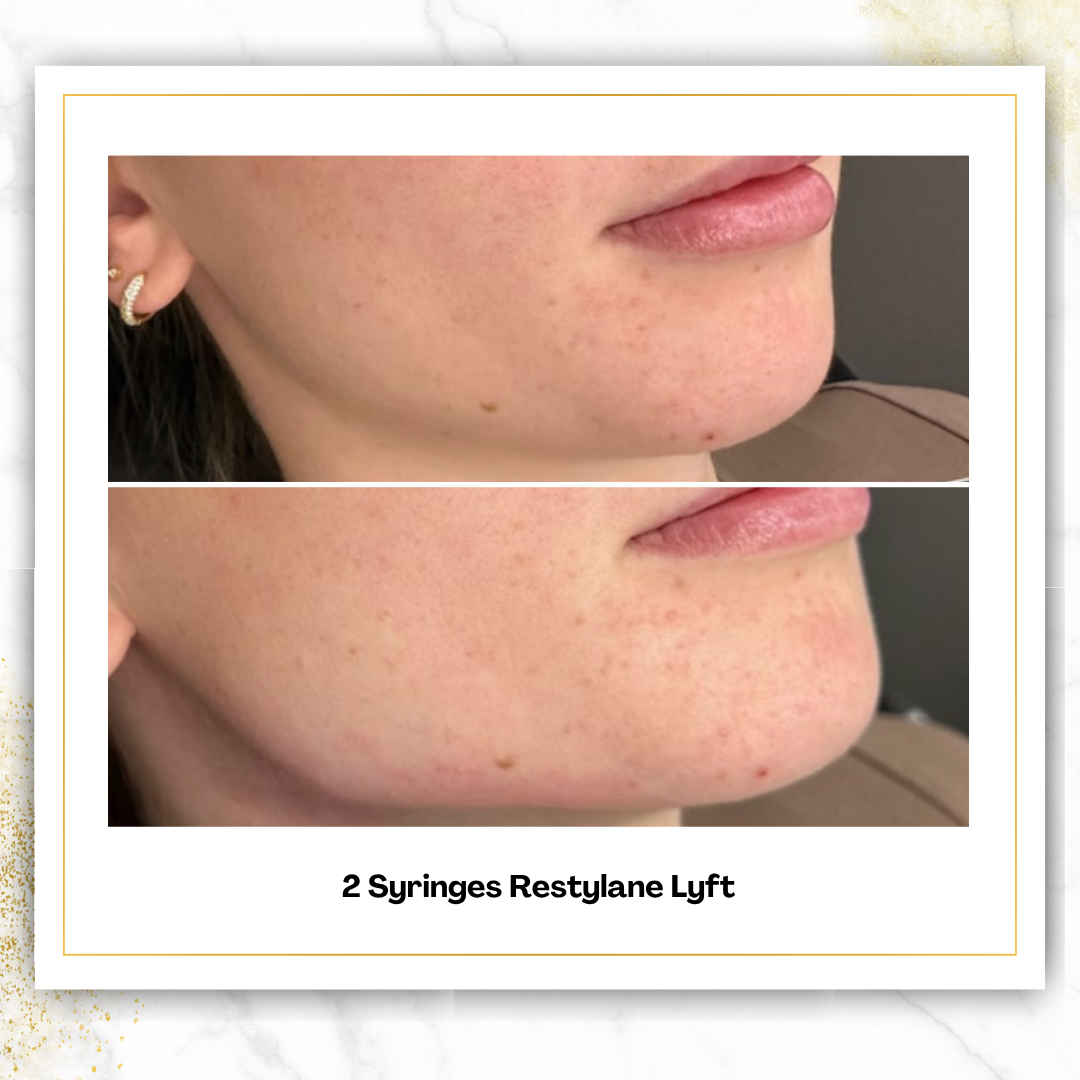 Restylane Lyft in San Antonio | $600 | Cheek Filler
