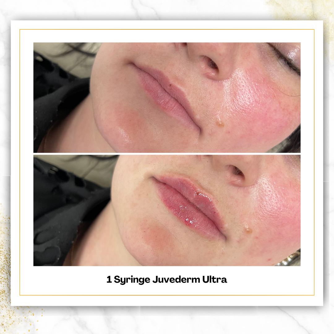 Juvederm Ultra Lip Filler in San Antonio | $500 | DaVida