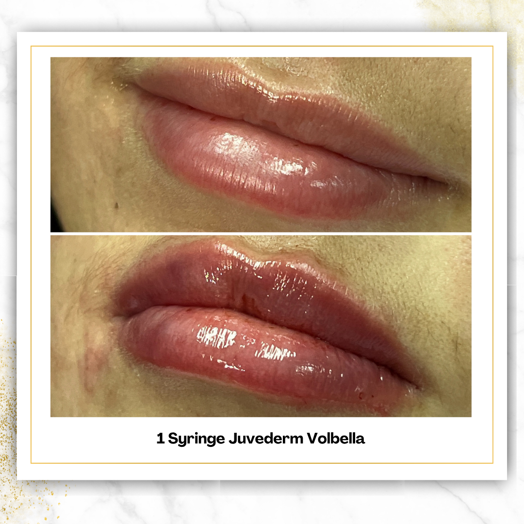 Juvederm Volbella in San Antonio | $650 Lip Filler