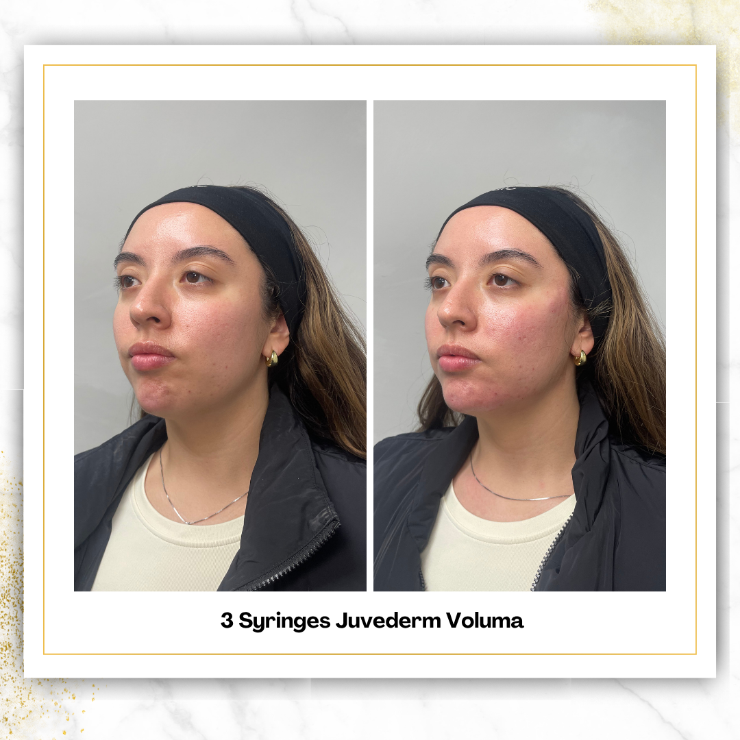 Juvederm Voluma Cheek Filler in San Antonio | DaVida