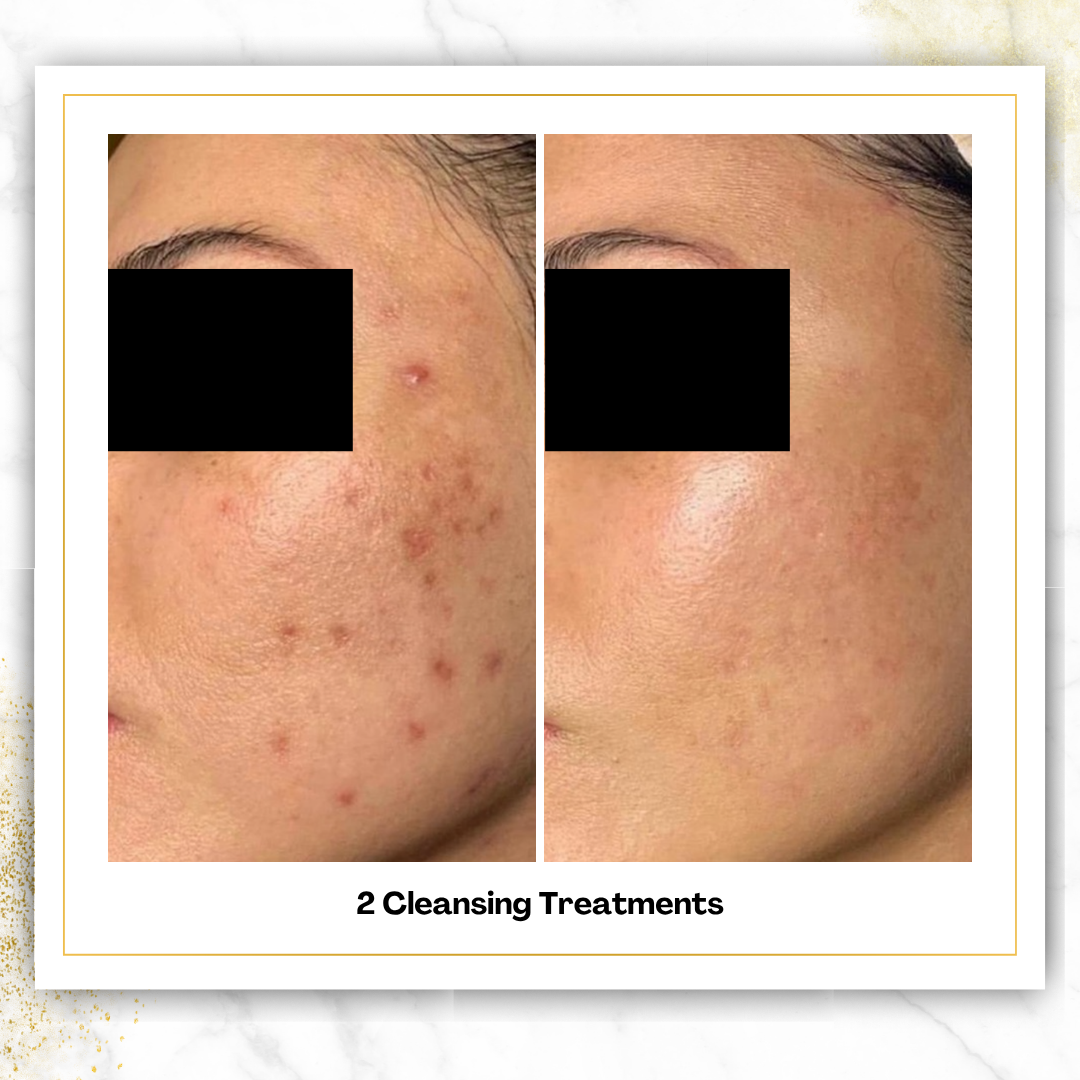 Cleansing Treatments in San Antonio | $75 | DaVida