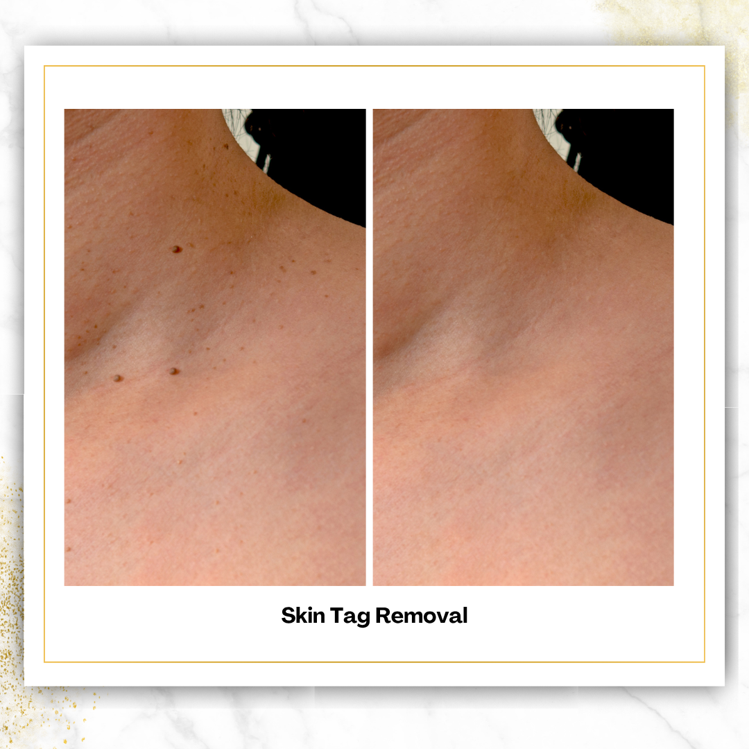 Skin Tag Removal in San Antonio | From $75 | DaVida