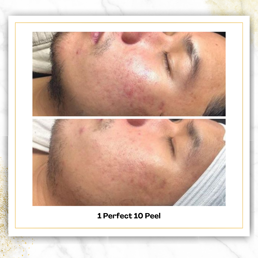 Perfect 10 Peel in San Antonio | $150 | DaVida Aesthetics