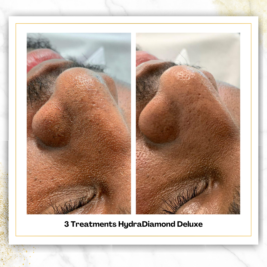 HydroDiamond Facial in San Antonio | From $150 | DaVida