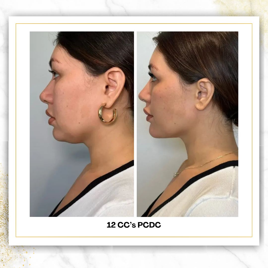 PCDC (Liquid Lipo) | 4 CC Unit Minimum