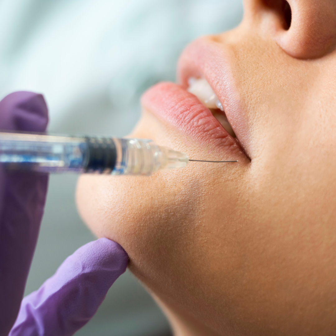 Juvederm Ultra (1 CC)