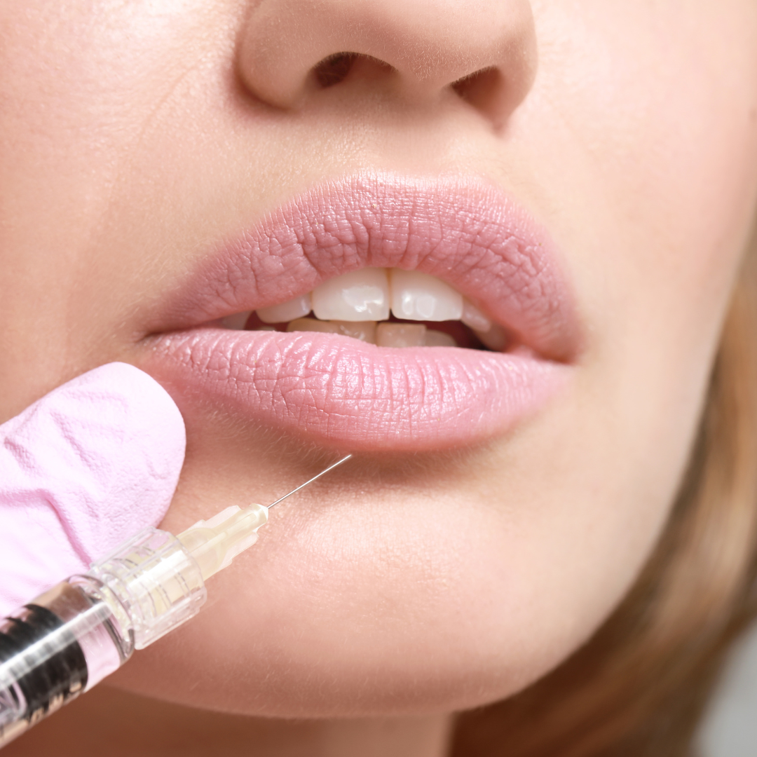 Restylane Kysse (1 CC)