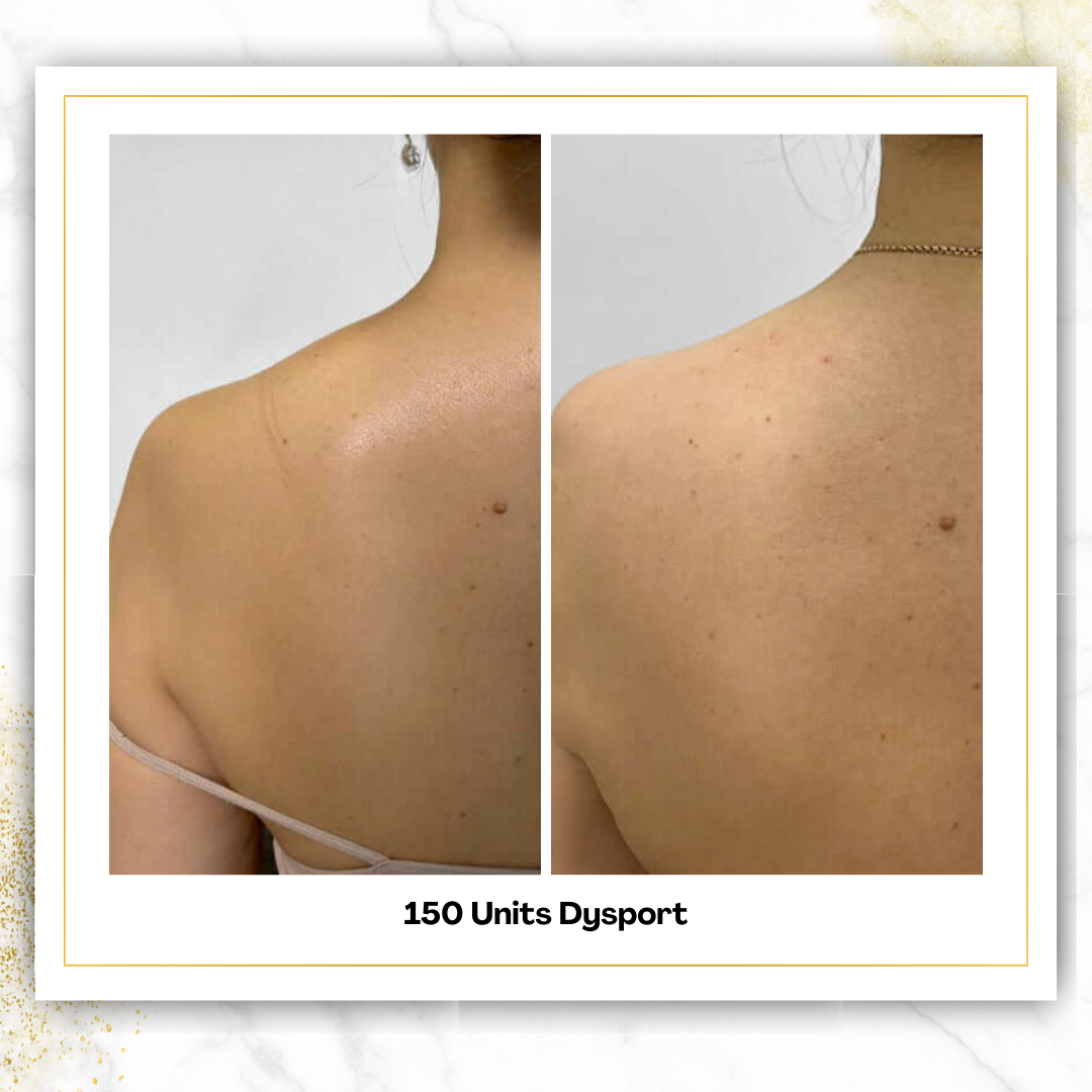 Dysport (150+ Units)