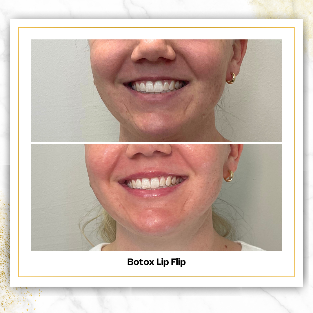 Lip Flip