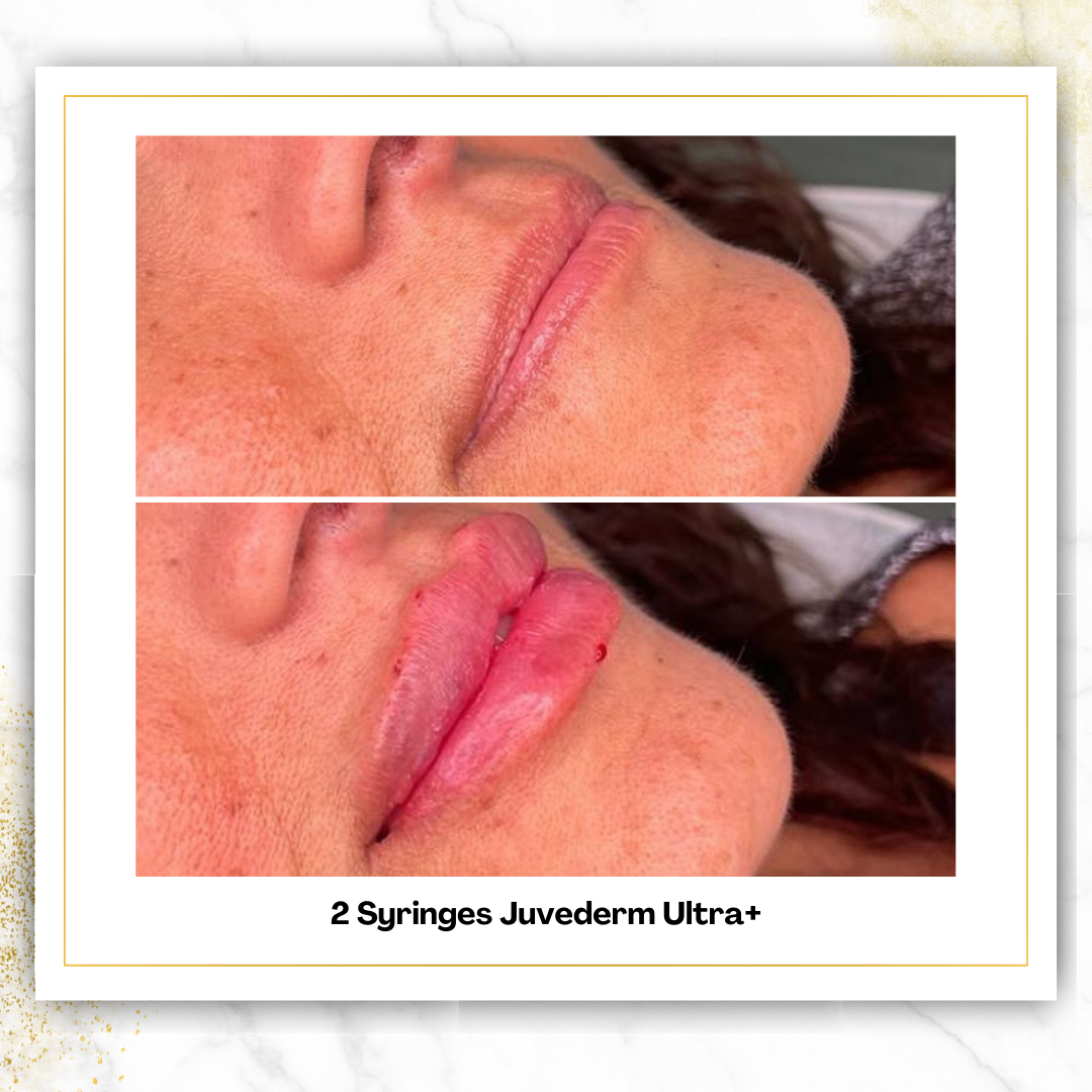 Juvederm Ultra +