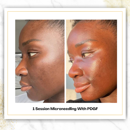 Microneedling With PDGF