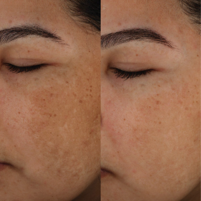 Epionce MelanoLyte Pigment Perfecting Serum