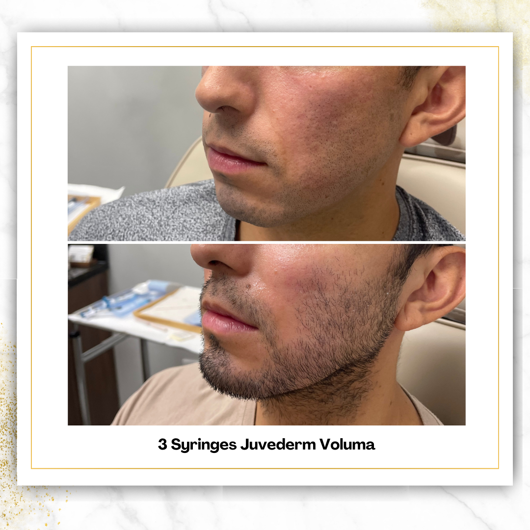 Juvederm Voluma
