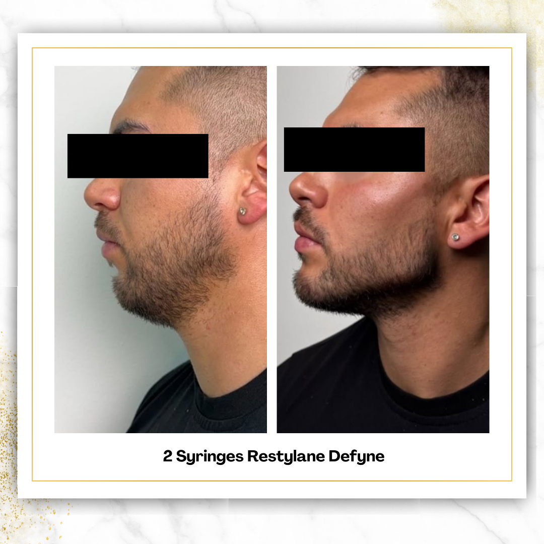 Restylane Defyne