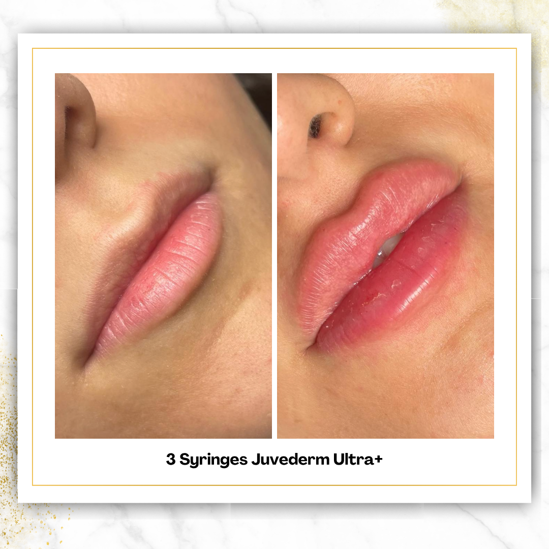 Juvederm Ultra+