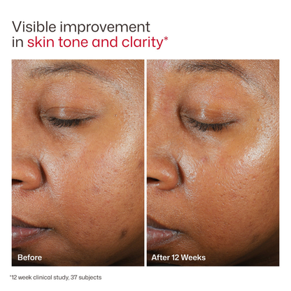 EltaMD UV Clear Sunscreen SPF 46 | Niacinamide