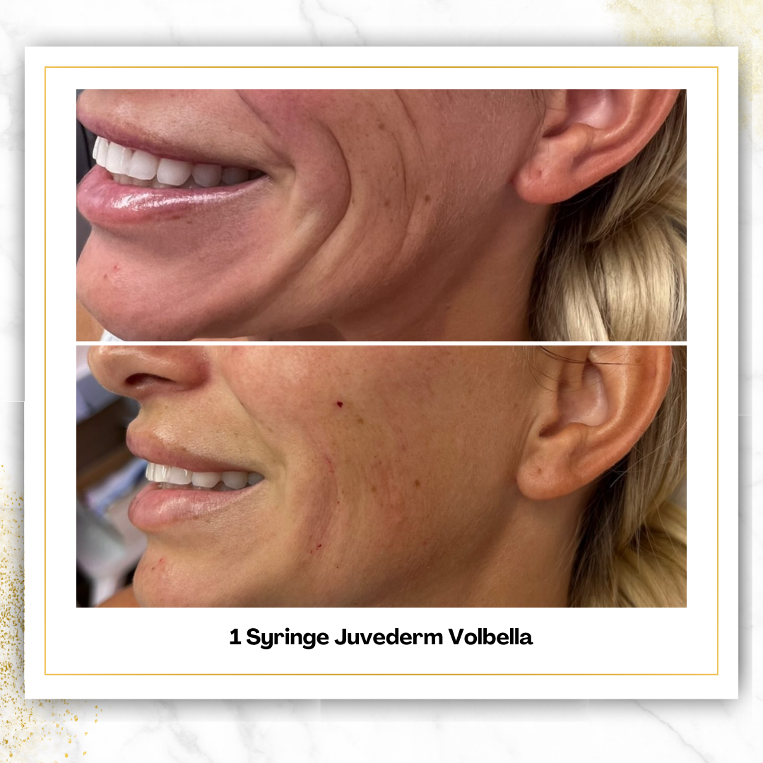 Juvederm Volbella