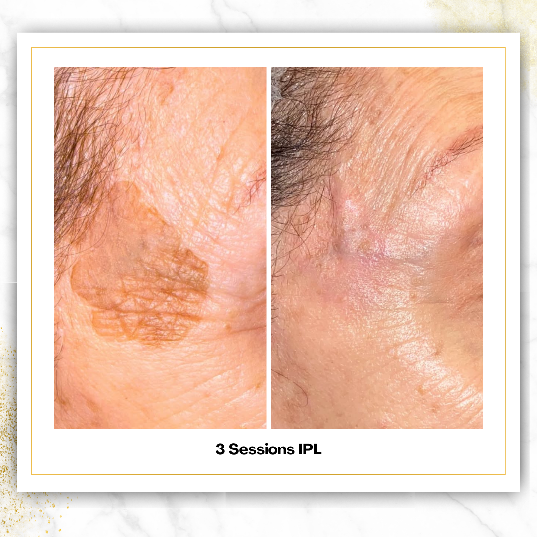 IPL (Brown Spot Removal)