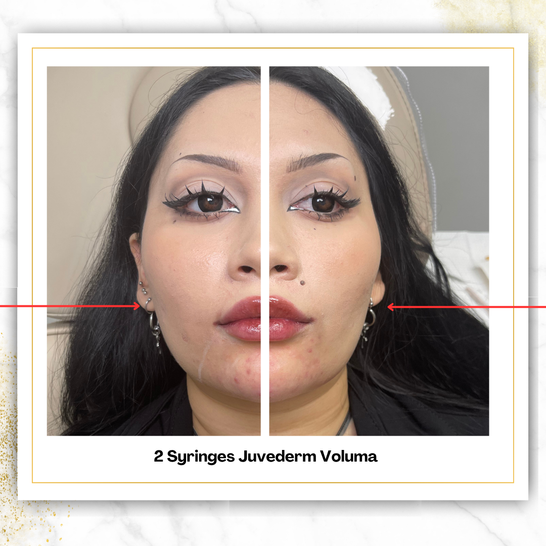 Juvederm Voluma
