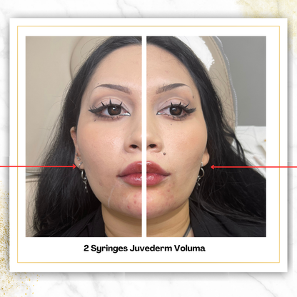Juvederm Voluma