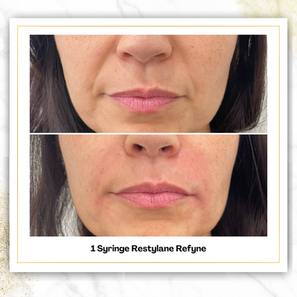 Restylane Refyne