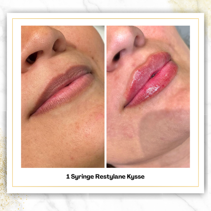 Restylane Kysse