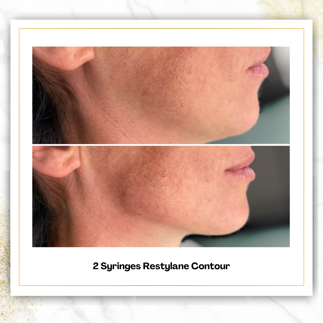 Restylane Contour