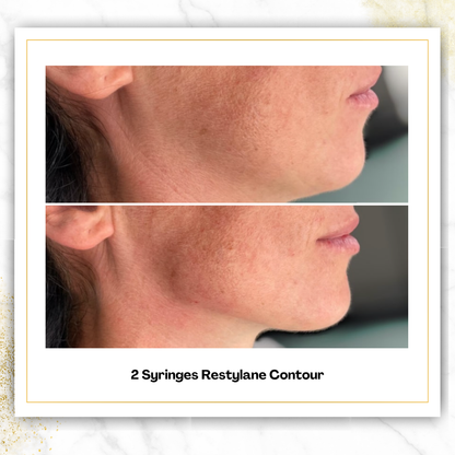 Restylane Contour