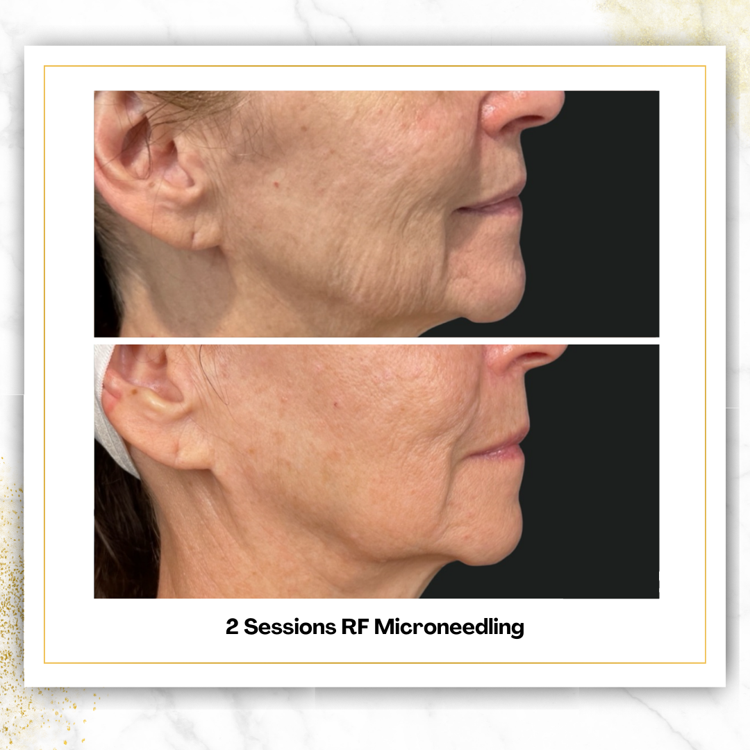Matrix Rf Microneedling