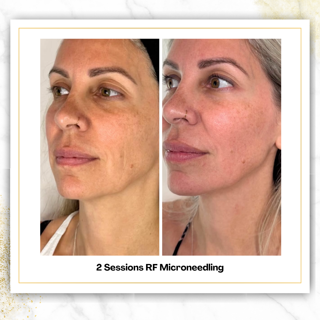 Matrix Rf Microneedling