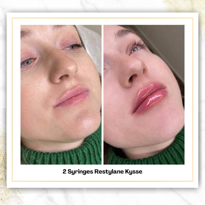 Restylane Kysse in San Antonio | Bold Lip Filler | $650
