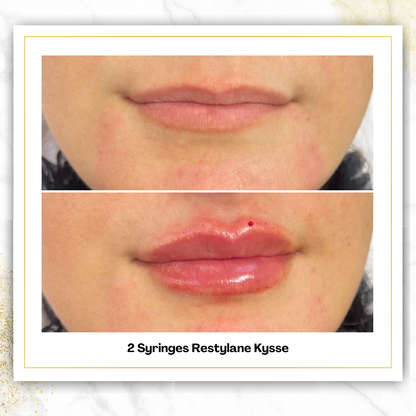 Restylane Kysse in San Antonio | Bold Lip Filler | $650
