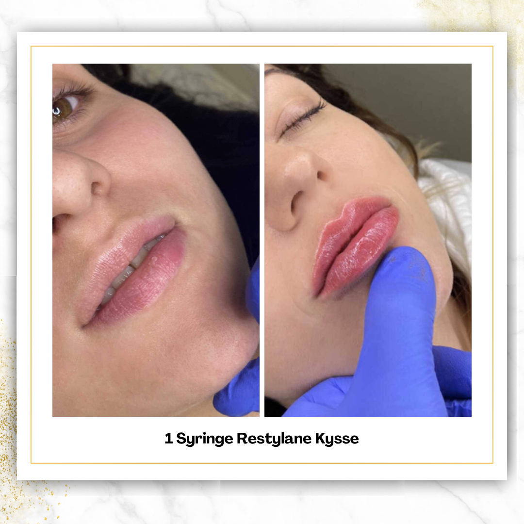 Restylane Kysse in San Antonio | Bold Lip Filler | $650