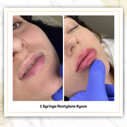 Restylane Kysse in San Antonio | Bold Lip Filler | $650