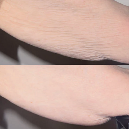 Alastin TransFORM Body Treatment for Crepey Skin