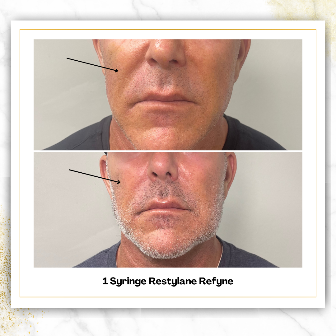 Restylane Refyne in San Antonio | Laugh Line Filler | $575