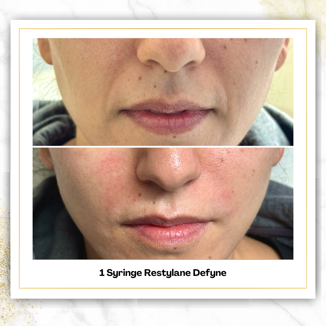 Restylane Defyne in San Antonio | Deep Laugh Lines | $575