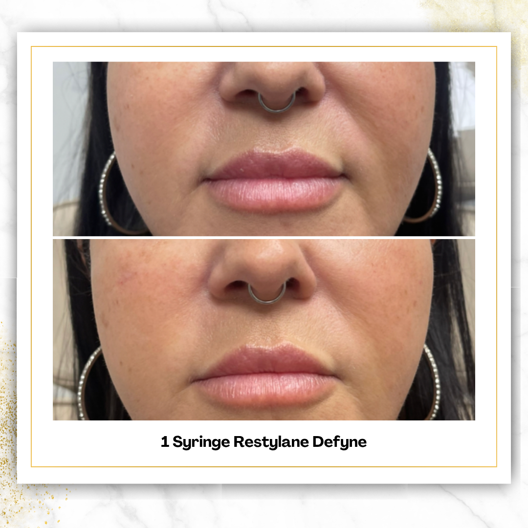 Restylane Defyne in San Antonio | Deep Laugh Lines | $575