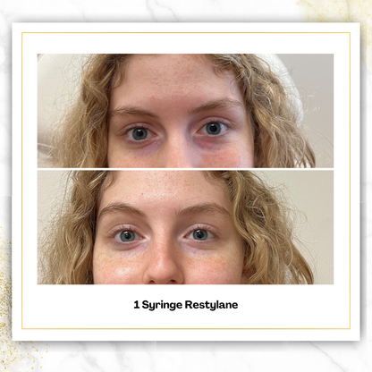 Restylane Under Eye Filler in San Antonio | $850 | DaVida