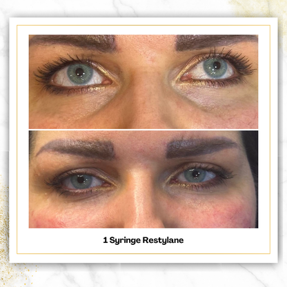 Restylane Under Eye Filler in San Antonio | $850 | DaVida