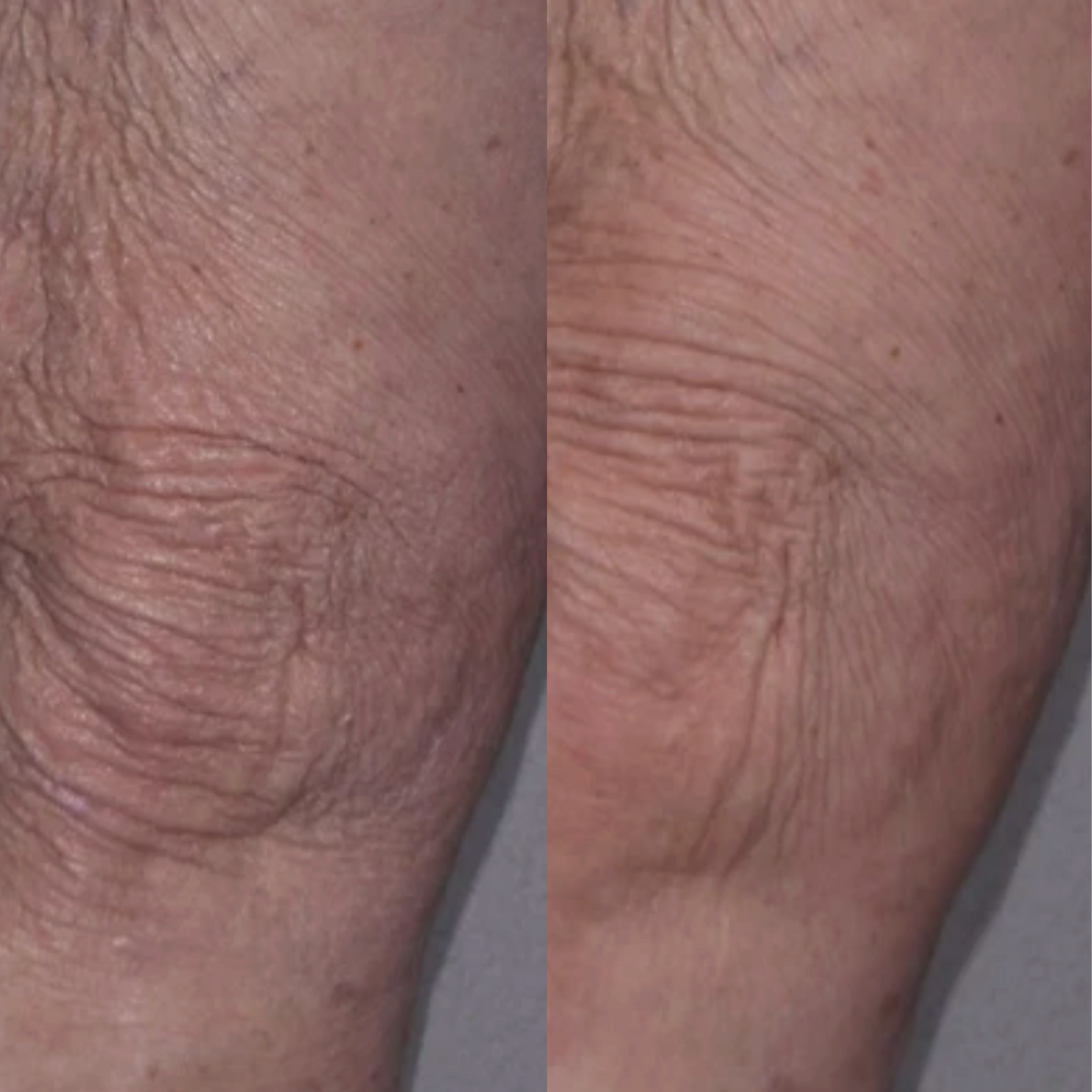 Alastin TransFORM Body Treatment for Crepey Skin