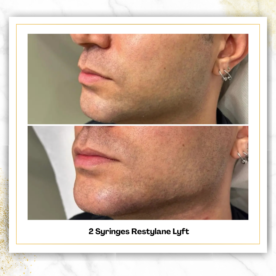 Restylane Lyft in San Antonio | $600 | Cheek Filler