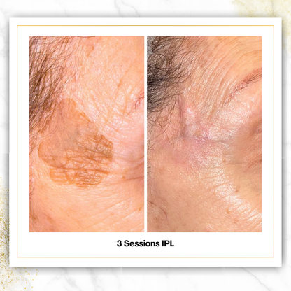 IPL Photofacial in San Antonio | From $125 | DaVida