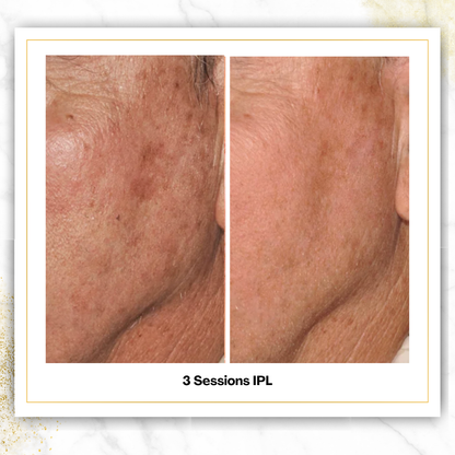 IPL Photofacial in San Antonio | From $125 | DaVida