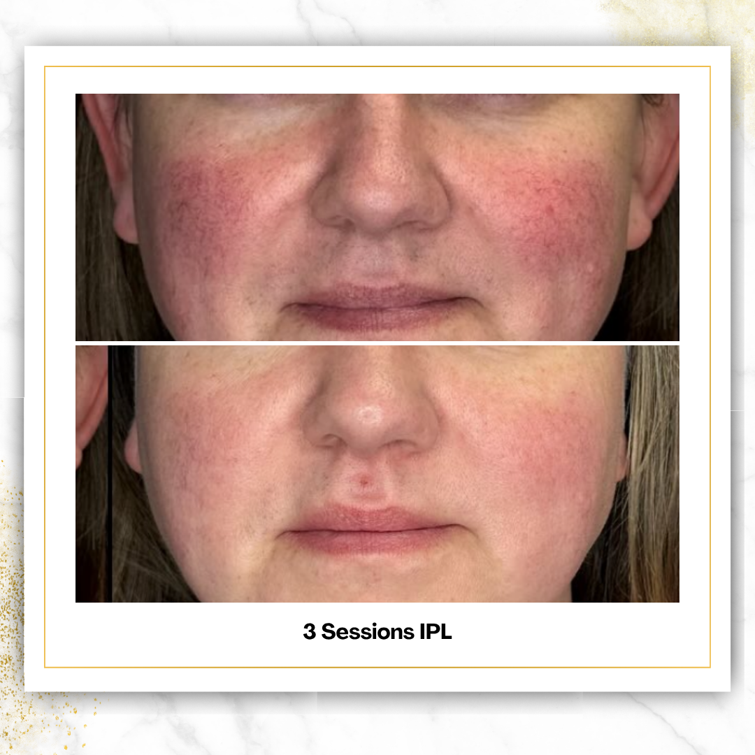 IPL Photofacial in San Antonio | From $125 | DaVida