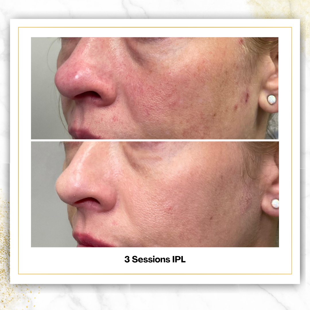 IPL Photofacial in San Antonio | From $125 | DaVida